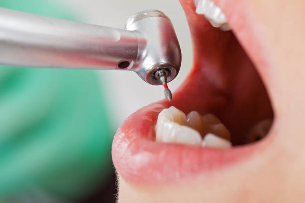 Best Broken or Cracked Tooth Emergency Dentist in Germantown, OH